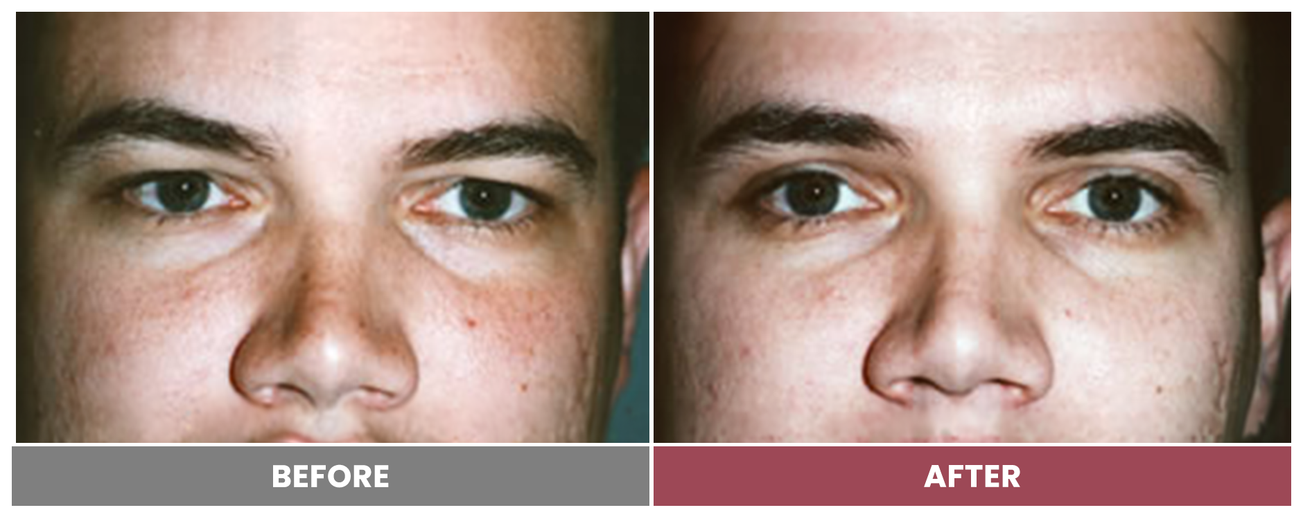 Upper Blepharoplasty - Case 80